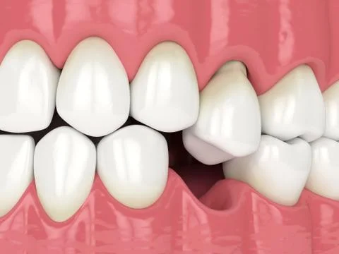 3d render of jaw with protruding tooth revealing root Illustrazione stock