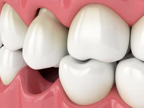 3d render of jaw with protruding tooth revealing root Stock Illustration