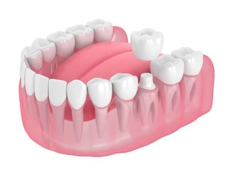 3d render of jaw with teeth and dental crown restoration Stock Illustration