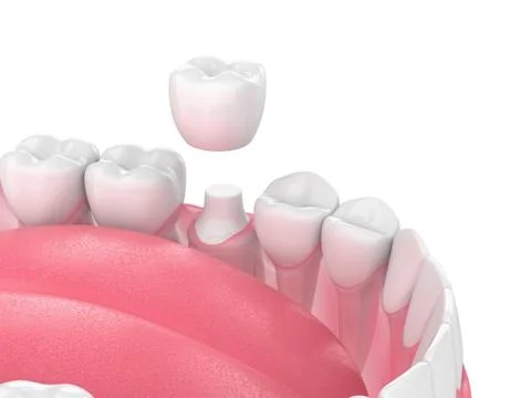 3d render of jaw with teeth and dental crown restoration Stock Illustration