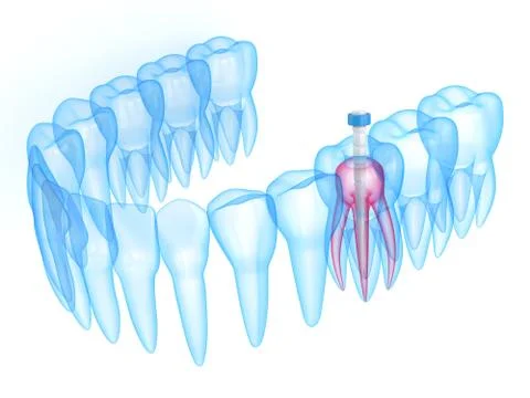 3d render of jaw with teeth and fiber post over white Stock Illustration
