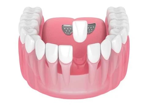 3d render of jaw with teeth and maryland bridge Illustrazione stock