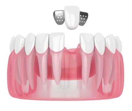 3d render of jaw with teeth and maryland bridge Stock Illustration