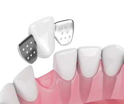 3d render of jaw with teeth and maryland bridge Stock Illustration