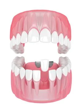 3d render of jaw with teeth and maryland bridge Stock Illustration