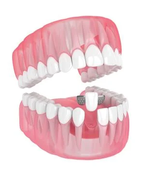 3d render of jaw with teeth and maryland bridge Stock Illustration
