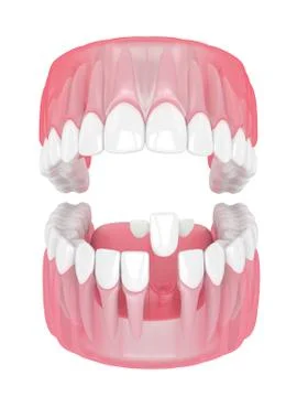 3d render of jaw with teeth and maryland bridge Stock Illustration