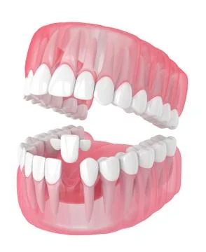 3d render of jaw with teeth and maryland bridge Stock Illustration