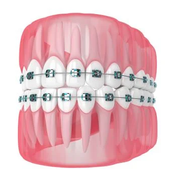 3d render of jaw with teeth and orthodontic braces Stock Illustration