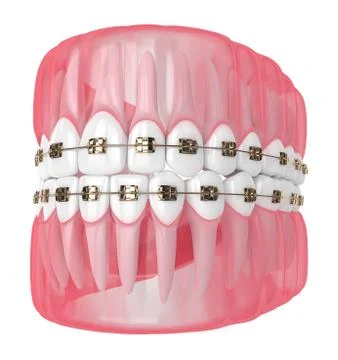 3d render of jaw with teeth and orthodontic braces Stock-Illustration