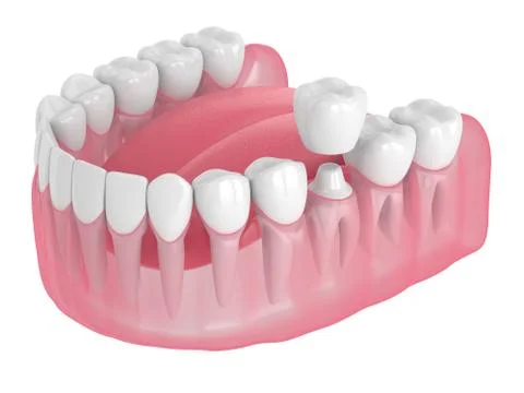 3d render of jaw with teeth and dental crown restoration Stock Illustration