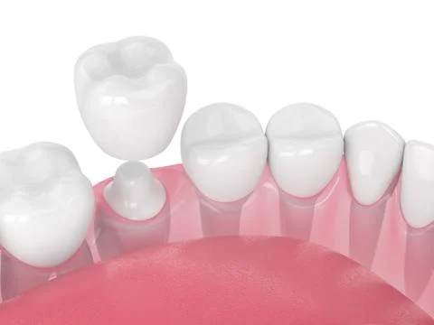 3d render of jaw with teeth and dental crown restoration Illustrazione stock
