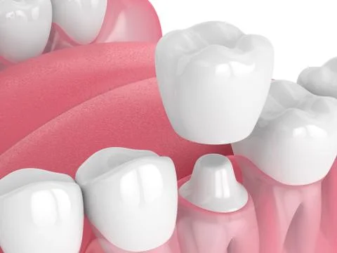 3d render of jaw with teeth and dental crown restoration Stock Illustration