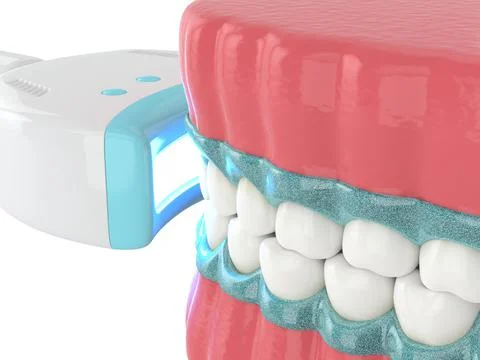 3d render of jaw with teeth bleaching by uv lamp Illustrazione stock
