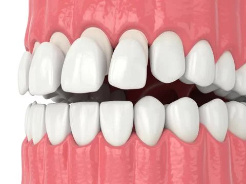 3d render of jaw with teethand upper veneers Stock Illustration