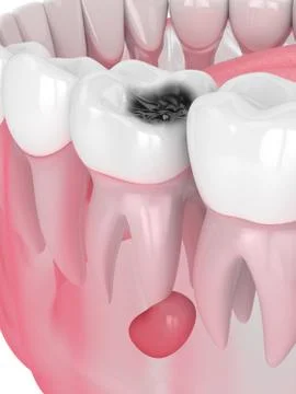 3d render of jaw with tooth cavity and cyst Stock Illustration