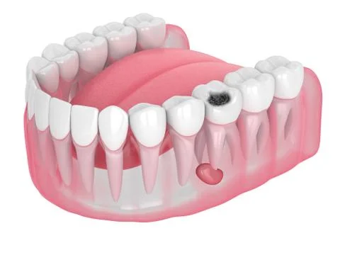3d render of jaw with tooth cavity and cyst Stock Illustration