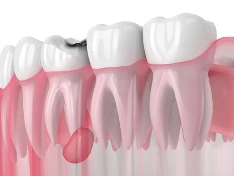 3d render of jaw with tooth cavity and cyst Illustrazione stock