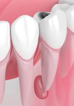 3d render of jaw with tooth cavity and cyst Stock Illustration