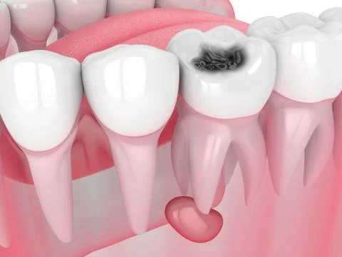 3d render of jaw with tooth cavity and cyst Stock Illustration