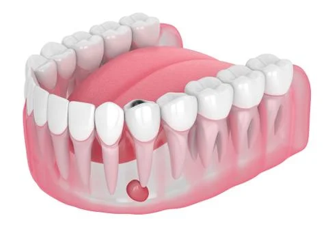 3d render of jaw with tooth cavity and cyst Illustrazione stock