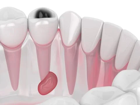 3d render of jaw with tooth cavity and cyst Stock Illustration