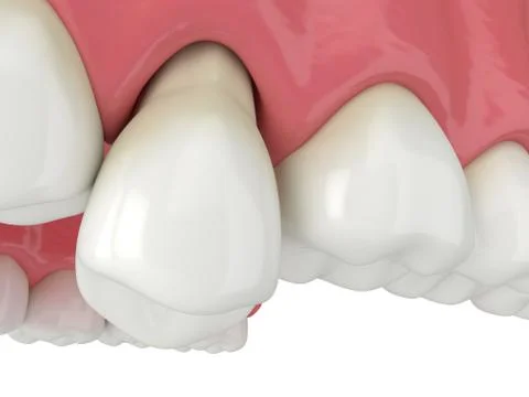 3d render of jaw with tooth protruding from the gums Stock Illustration
