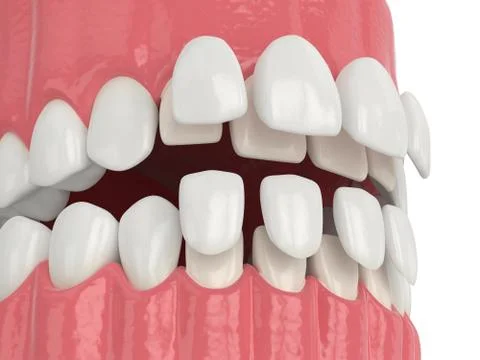 3d render of jaw with upper and lower veneers Stock Illustration