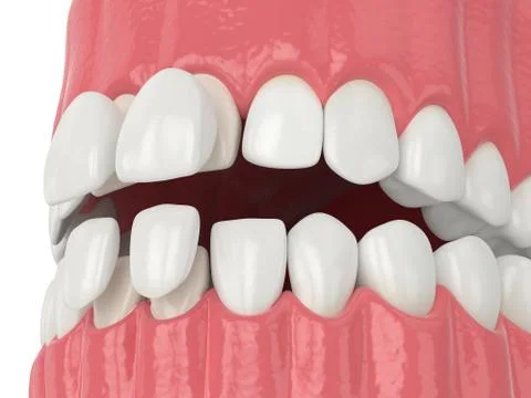3d render of jaw with upper and lower veneers Stock-Illustration
