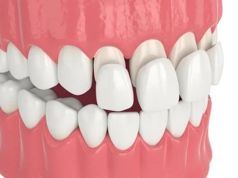 3d render of jaw with upper veneers Stock Photos