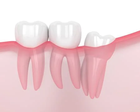 3d render of jaw with wisdom distal impaction Stock Illustration
