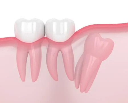 3d render of jaw with wisdom distal impaction Stock Illustration