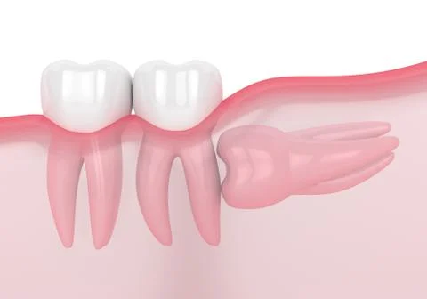 3d render of jaw with wisdom horizontal impaction Stock Illustration