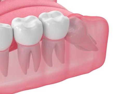 3d render of jaw with wisdom mesial impaction Illustrazione stock