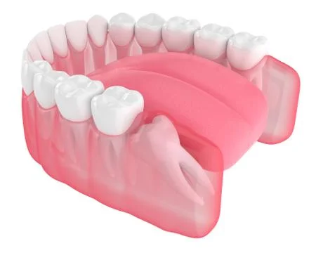 3d render of jaw with wisdom mesial impaction Stock Illustration