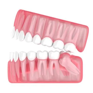 3d render of jaw with wisdom mesial impaction Illustrazione stock