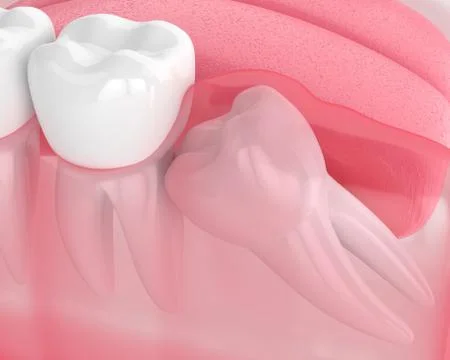 3d render of jaw with wisdom mesial impaction Stock Illustration