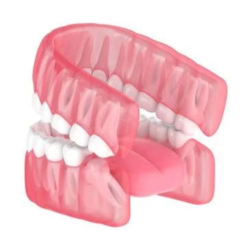 3d render of jaw with wisdom mesial impaction Illustrazione stock