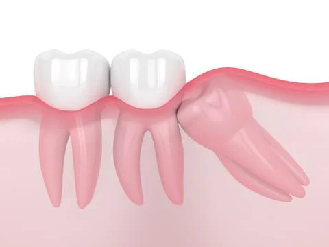 3d render of jaw with wisdom mesial impaction Stock Illustration