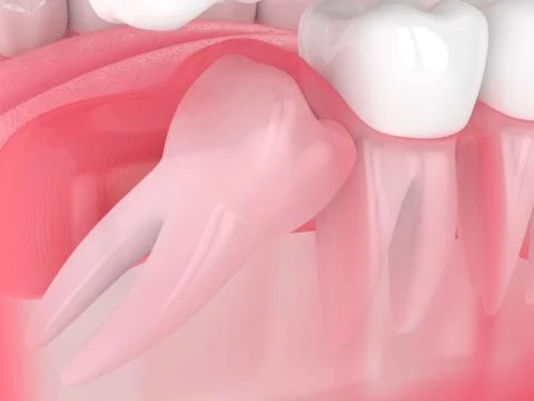 3d render of jaw with wisdom mesial impaction Stock-Illustration