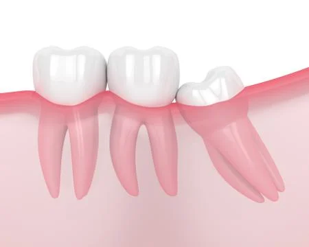3d render of jaw with wisdom mesial impaction Stock Illustration