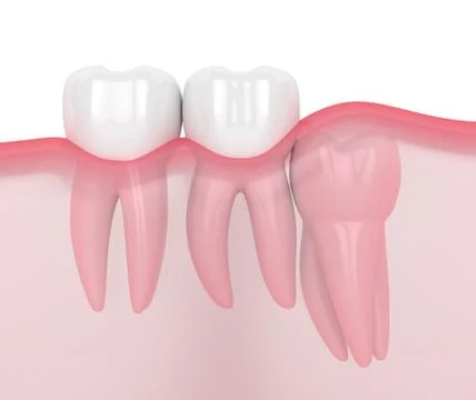 3d render of jaw with wisdom vertical impaction Illustrazione stock