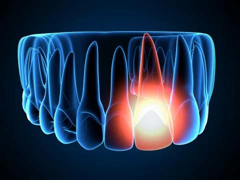 3d render of  jaw x-ray with throbbing toothache Stock Illustration