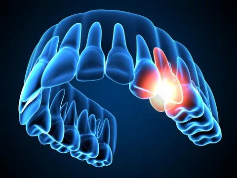 3d render of  jaw x-ray with throbbing toothache Stock Illustration