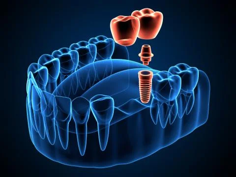 3d render of jaw x-ray with dental cantilever bridge Illustrazione stock
