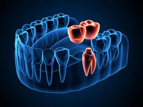 3d render of jaw x-ray with dental cantilever bridge Stock Illustration