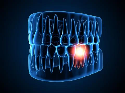 3d render of  jaw x-ray with aching tooth Stock Illustration
