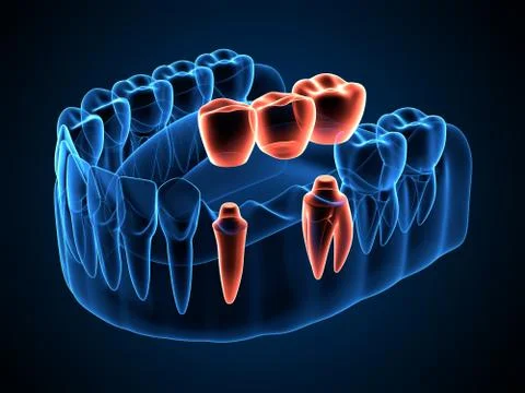 3d render of jaw x-ray with dental bridge over molar and premolar teeth Stock Illustration