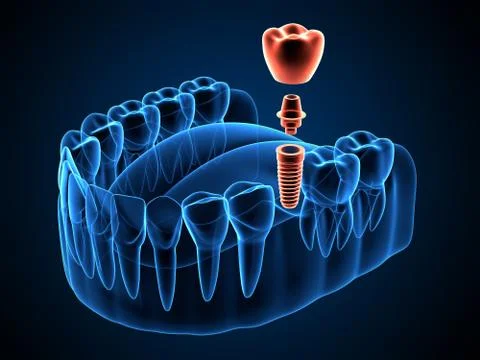 3d render of jaw x-ray  with dental implant placement Stock Illustration