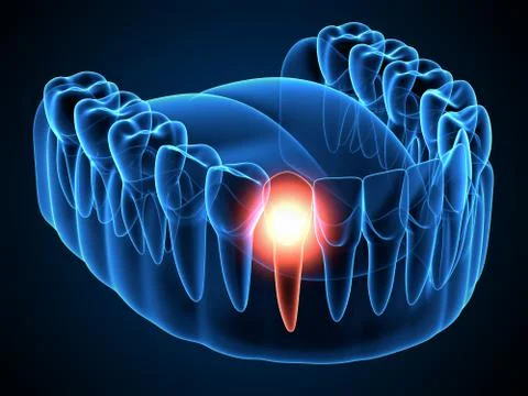 3d render of  jaw x-ray with aching tooth Stock Illustration